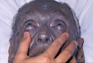 Silver Toxicity | Silver Poisoning | Argyria
