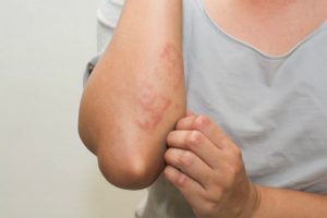 The Herxheimer Reaction Symptoms | Skin Rash